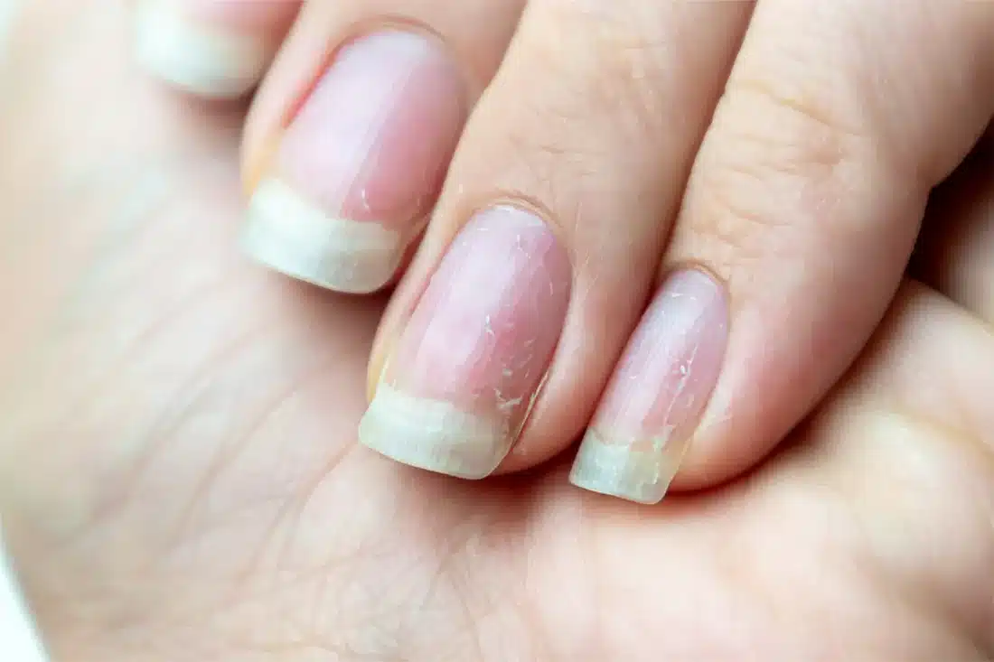 ongles-fragiles